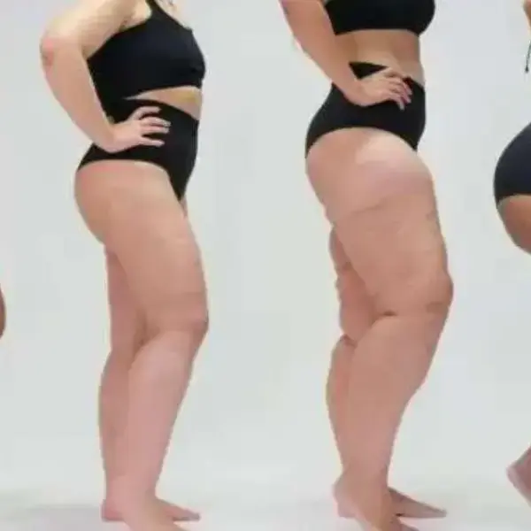 Lipedema e corrida: quando correr ajuda e quais cuidados tomar