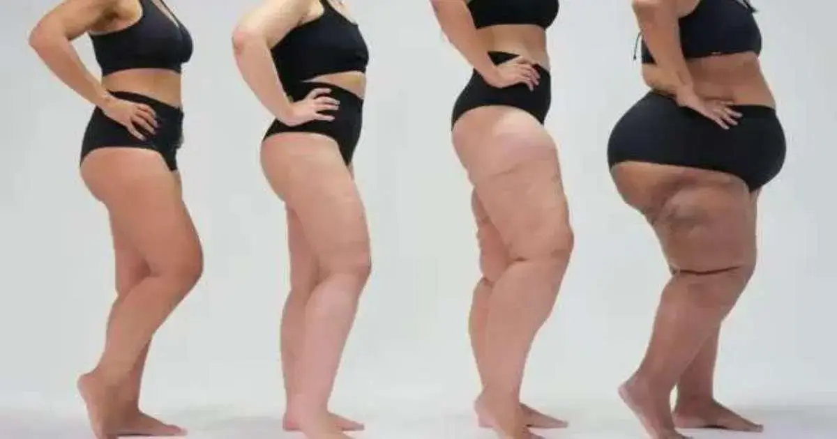 Lipedema e corrida: quando correr ajuda e quais cuidados tomar